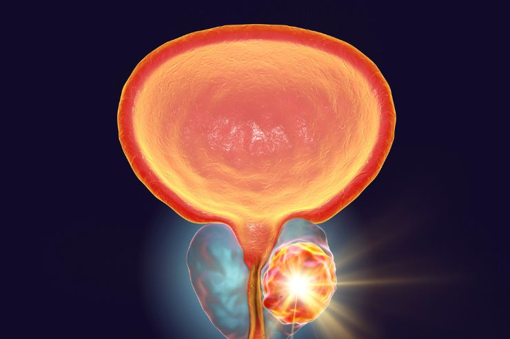 Bladder Cancer